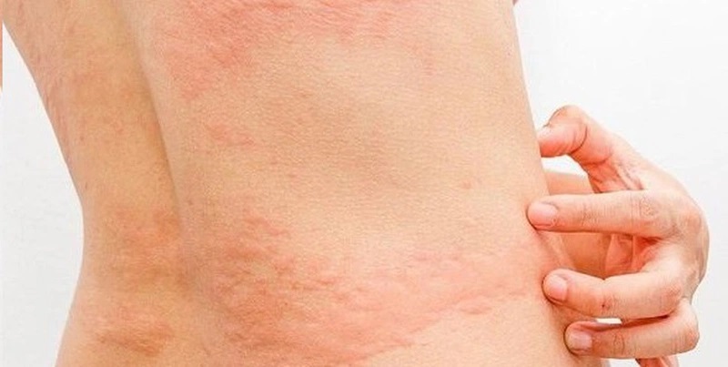 Ngứa dai dẳng, mệt mỏi không rõ nguyên nhân? Có thể bạn đang nhiễm sán chó mà không hề hay biết!